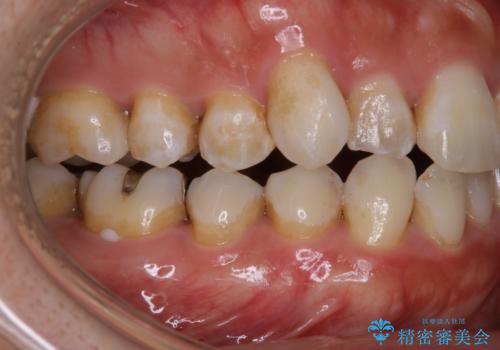 治療前にPMTCでステイン・黄ばみの除去の症例 治療前