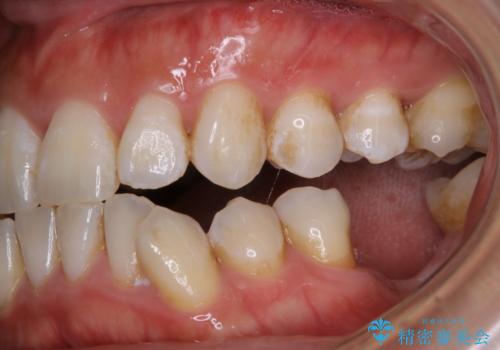 治療前にPMTCでステイン・黄ばみの除去の治療前