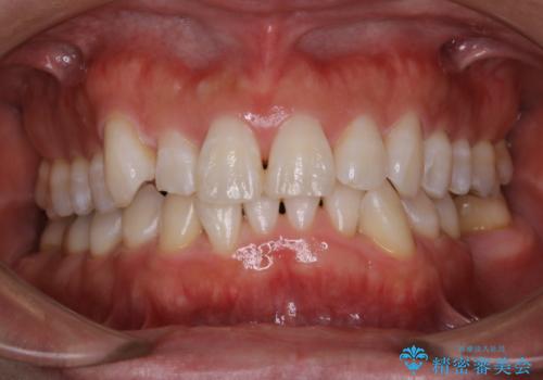 治療前にPMTCでステイン・黄ばみの除去の治療後