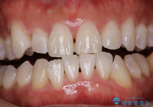治療前にPMTCでステイン・黄ばみの除去の治療後