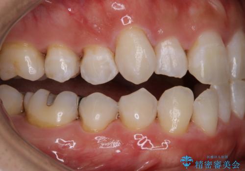 治療前にPMTCでステイン・黄ばみの除去の症例 治療後