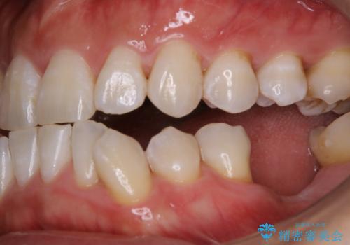 治療前にPMTCでステイン・黄ばみの除去の治療後