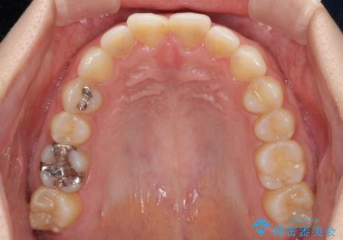 矯正治療の後戻り　ガタガタになった前歯の部分矯正の治療前