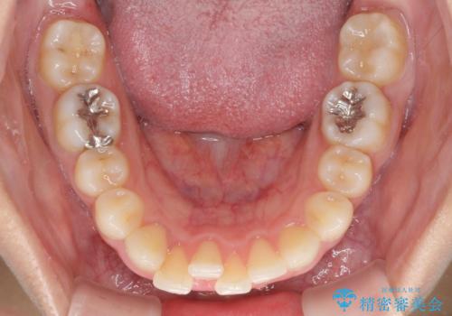 矯正治療の後戻り　ガタガタになった前歯の部分矯正の治療前