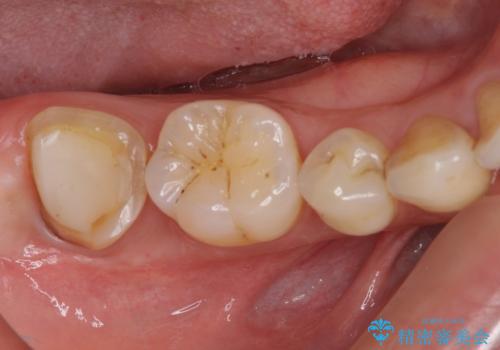 根管治療後の補綴治療　奥歯のセラミッククラウンの治療前