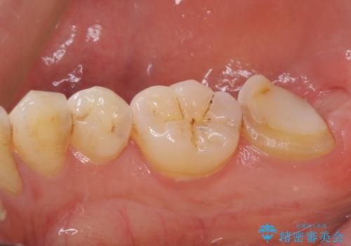 根管治療後の補綴治療 奥歯のセラミッククラウンの治療前