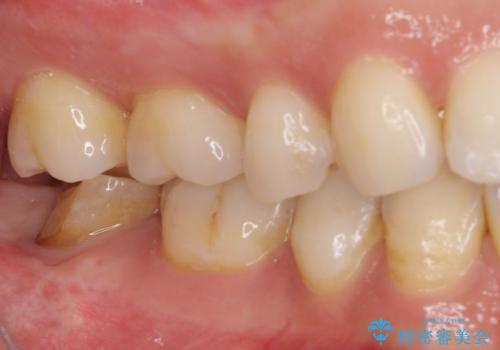 根管治療後の補綴治療 奥歯のセラミッククラウンの治療前