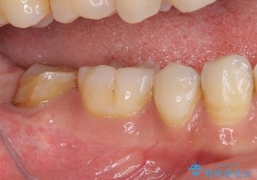 根管治療後の補綴治療 奥歯のセラミッククラウンの治療前