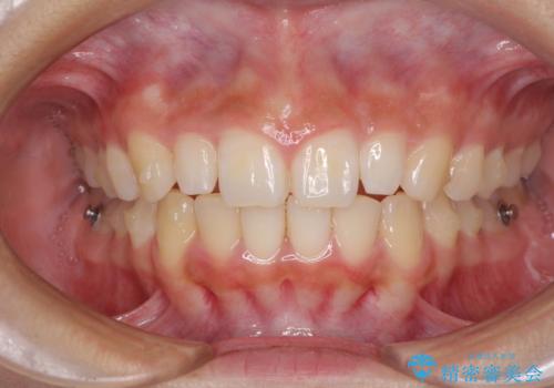 前歯のデコボコを治したい インビザラインによる矯正治療の治療中