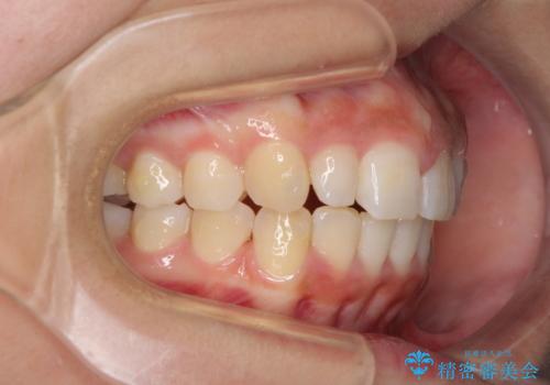 前歯のデコボコを治したい　インビザラインによる矯正治療の治療中