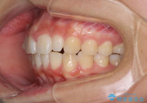 前歯のデコボコを治したい インビザラインによる矯正治療の治療中