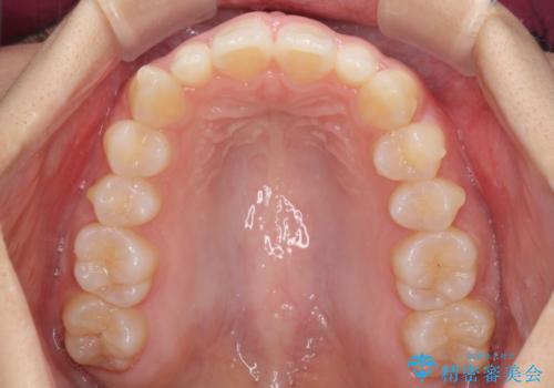 前歯のデコボコを治したい インビザラインによる矯正治療の治療中