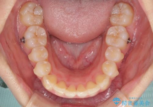 前歯のデコボコを治したい インビザラインによる矯正治療の治療中