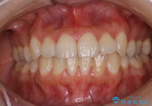 インビザラインでの矯正治療前にPMTCで歯のクリーニングの治療前