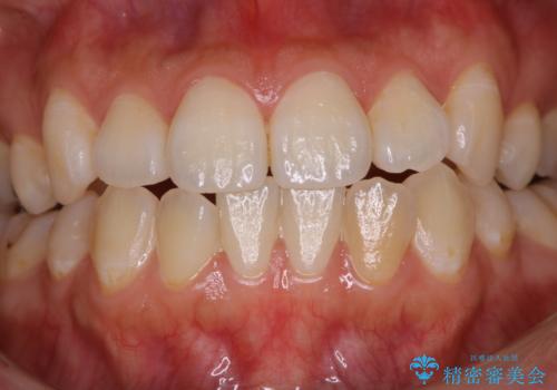 インビザラインでの矯正治療前にPMTCで歯のクリーニングの症例 治療前