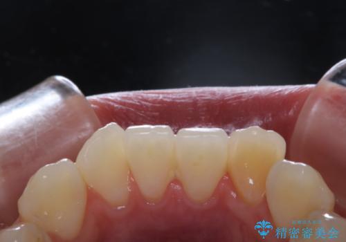 インビザラインでの矯正治療前にPMTCで歯のクリーニングの治療前