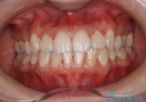 インビザラインでの矯正治療前にPMTCで歯のクリーニングの治療後