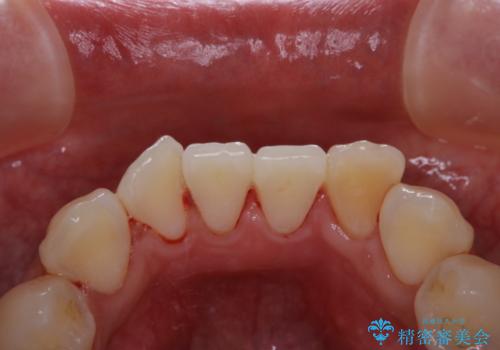 インビザラインでの矯正治療前にPMTCで歯のクリーニングの治療後