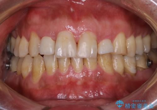 invisalign矯正治療中のPMTC　歯のクリーニングの治療前