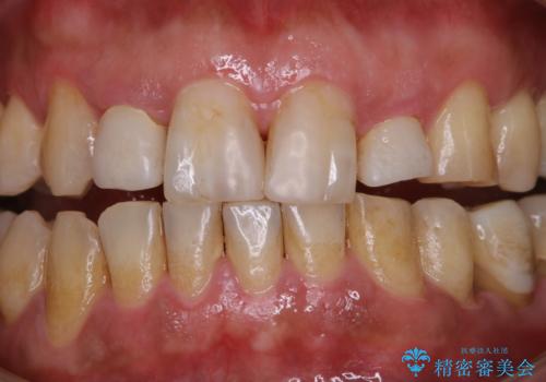 invisalign矯正治療中のPMTC　歯のクリーニングの治療前