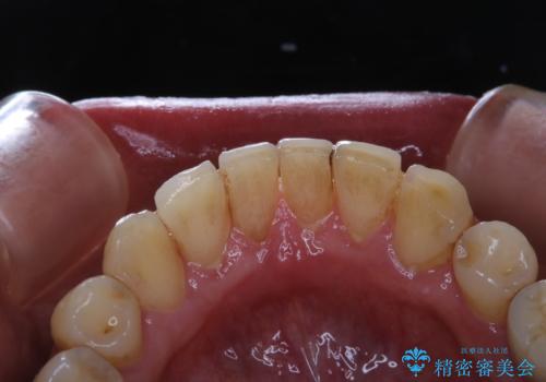 invisalign矯正治療中のPMTC 歯のクリーニングの治療前