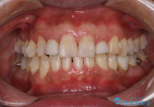 invisalign矯正治療中のPMTC　歯のクリーニングの治療後