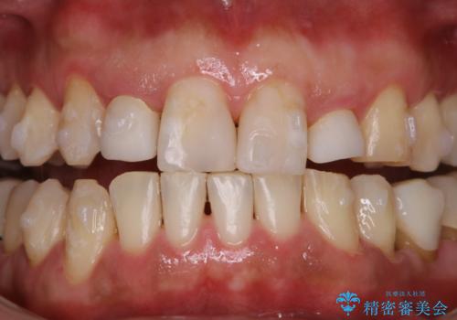 invisalign矯正治療中のPMTC　歯のクリーニング