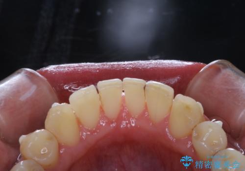 invisalign矯正治療中のPMTC 歯のクリーニングの治療後