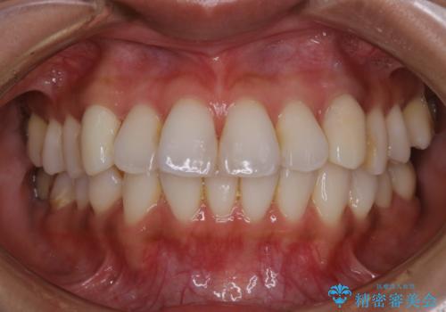 PMTCとホワイトニングの治療前