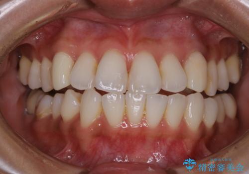 PMTCとホワイトニングの治療前