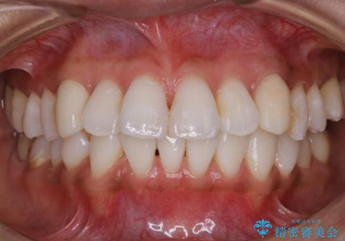 PMTCとホワイトニングの治療後