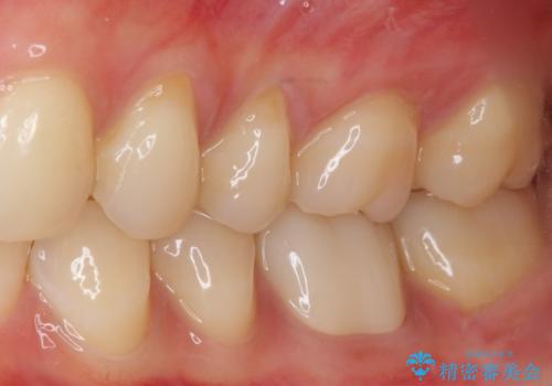 奥歯が痛い 根管治療とオールセラミッククラウンの治療後
