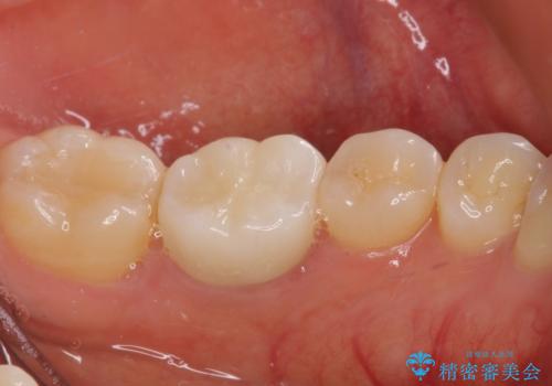 奥歯が痛い 根管治療とオールセラミッククラウンの治療後