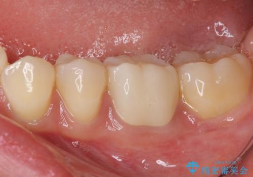 奥歯が痛い 根管治療とオールセラミッククラウンの治療後