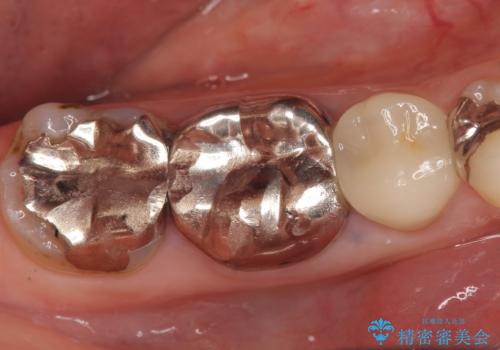 オールセラミッククラウン 歯茎が腫れてくる歯の治療の治療前