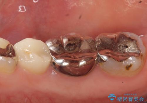 オールセラミッククラウン 歯茎が腫れてくる歯の治療の治療前