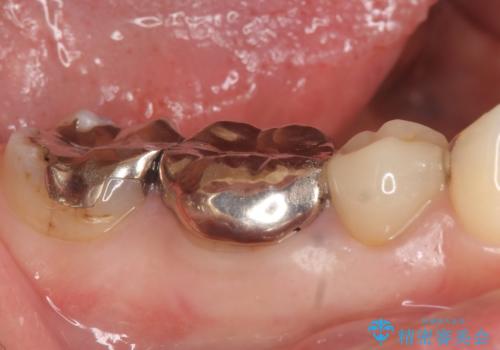 オールセラミッククラウン　歯茎が腫れてくる歯の治療の治療前