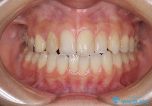 後戻りを治したい 骨格的なズレの大きい方のインビザライン矯正の治療中