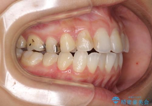 後戻りを治したい 骨格的なズレの大きい方のインビザライン矯正の治療中