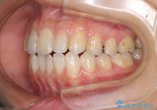 後戻りを治したい 骨格的なズレの大きい方のインビザライン矯正の治療中