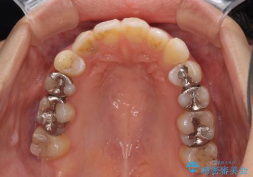 後戻りを治したい 骨格的なズレの大きい方のインビザライン矯正の治療中