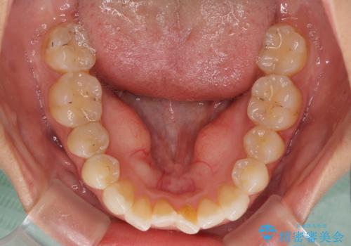 後戻りを治したい 骨格的なズレの大きい方のインビザライン矯正の治療中