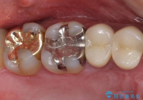 外れてしまった奥歯の銀歯　ゴールドインレーによる修復治療の症例 治療後