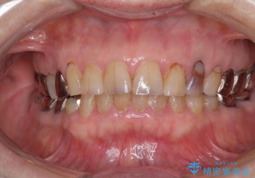 全ての奥歯の銀歯をセラミックに　メタルフリー治療の治療前