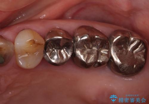 全ての奥歯の銀歯をセラミックに　メタルフリー治療の治療前