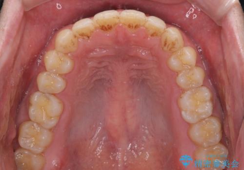 すきっ歯の改善　インビザライン矯正治療の治療後