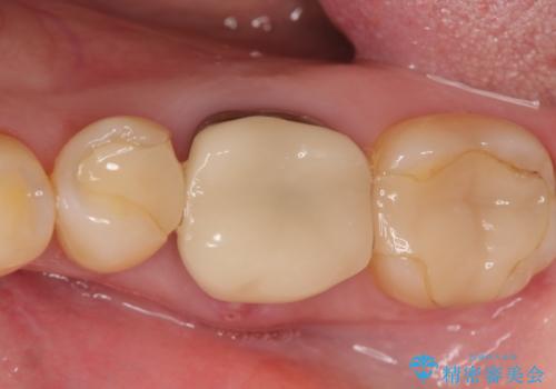 インプラント 割れてしまった歯の治療の治療前