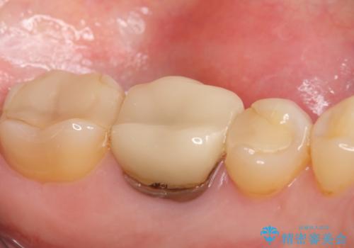 インプラント 割れてしまった歯の治療の治療前