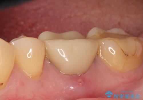 インプラント 割れてしまった歯の治療の症例 治療前
