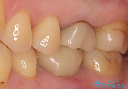 インプラント 割れてしまった歯の治療の治療前